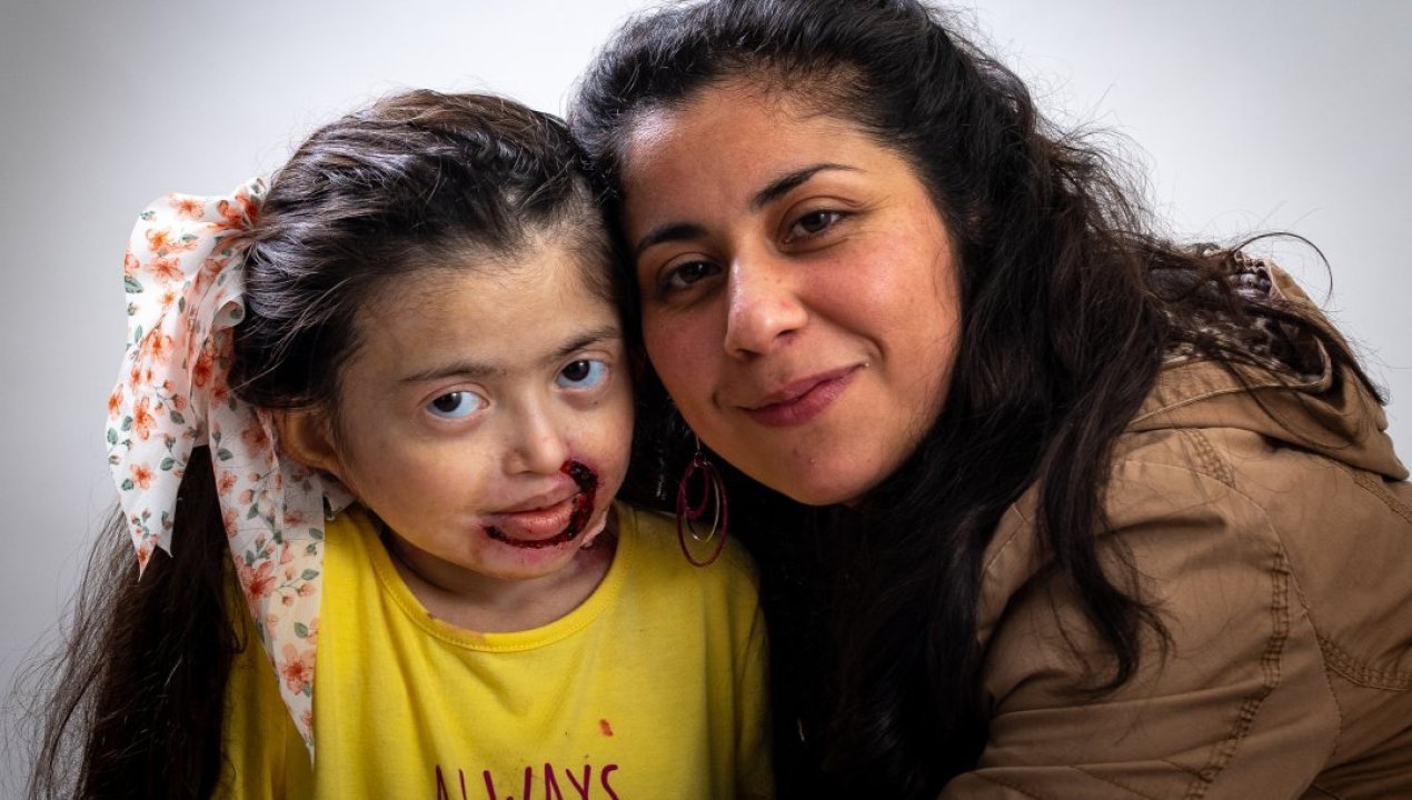 /dia-de-la-piel-de-cristal-en-que-consiste-esta-condicion-y-que-tan